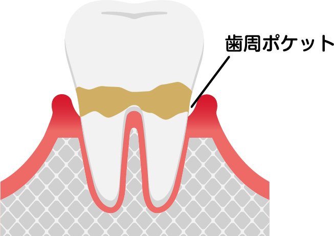 軽度歯周病の場合