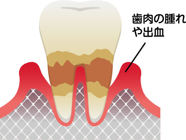 中等度歯周病の場合