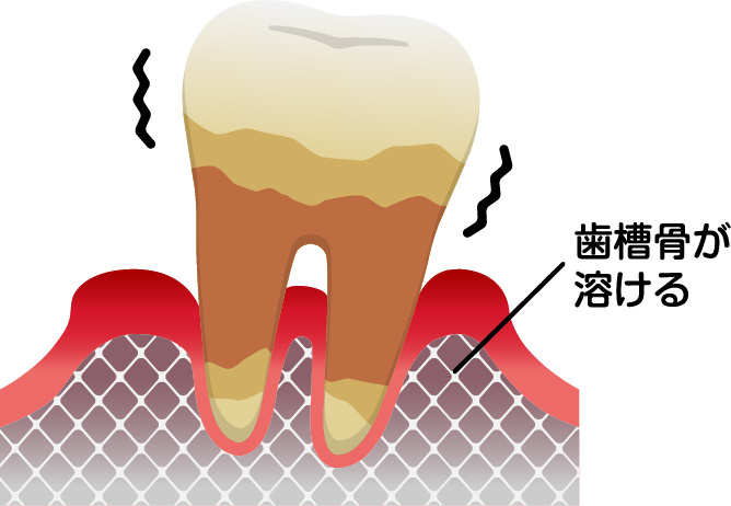 重度歯周病の場合