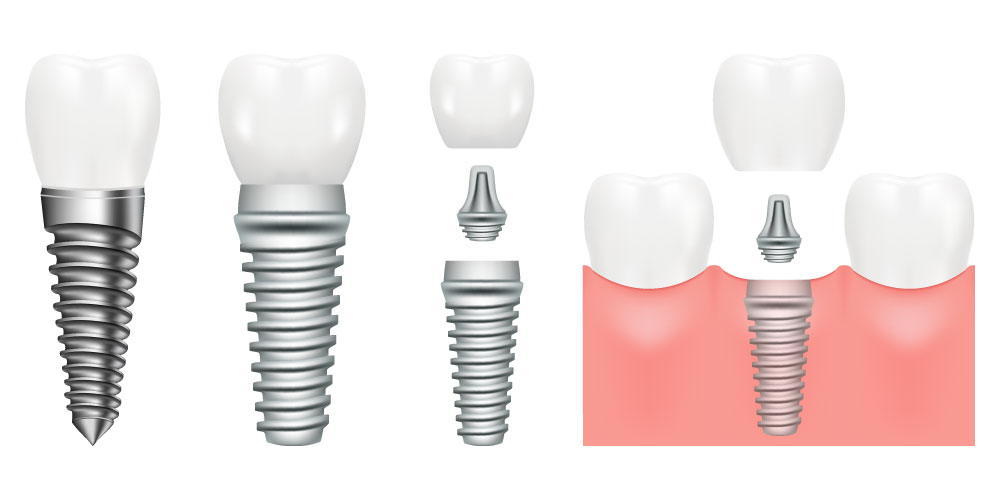 インプラントの構造と素材