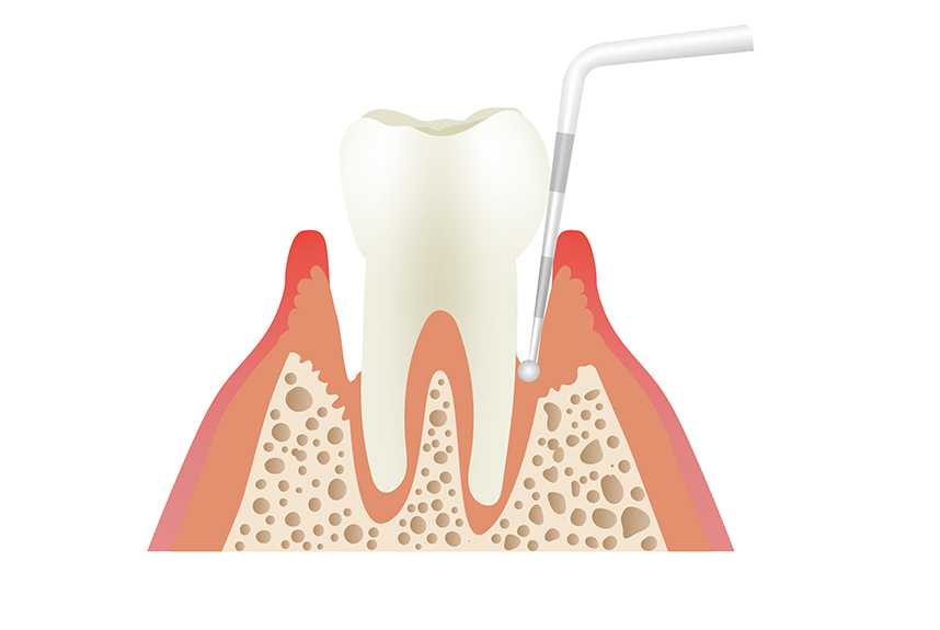 歯周ポケット検査