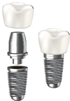 インプラント治療